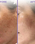anti pigmentation combo before and after
