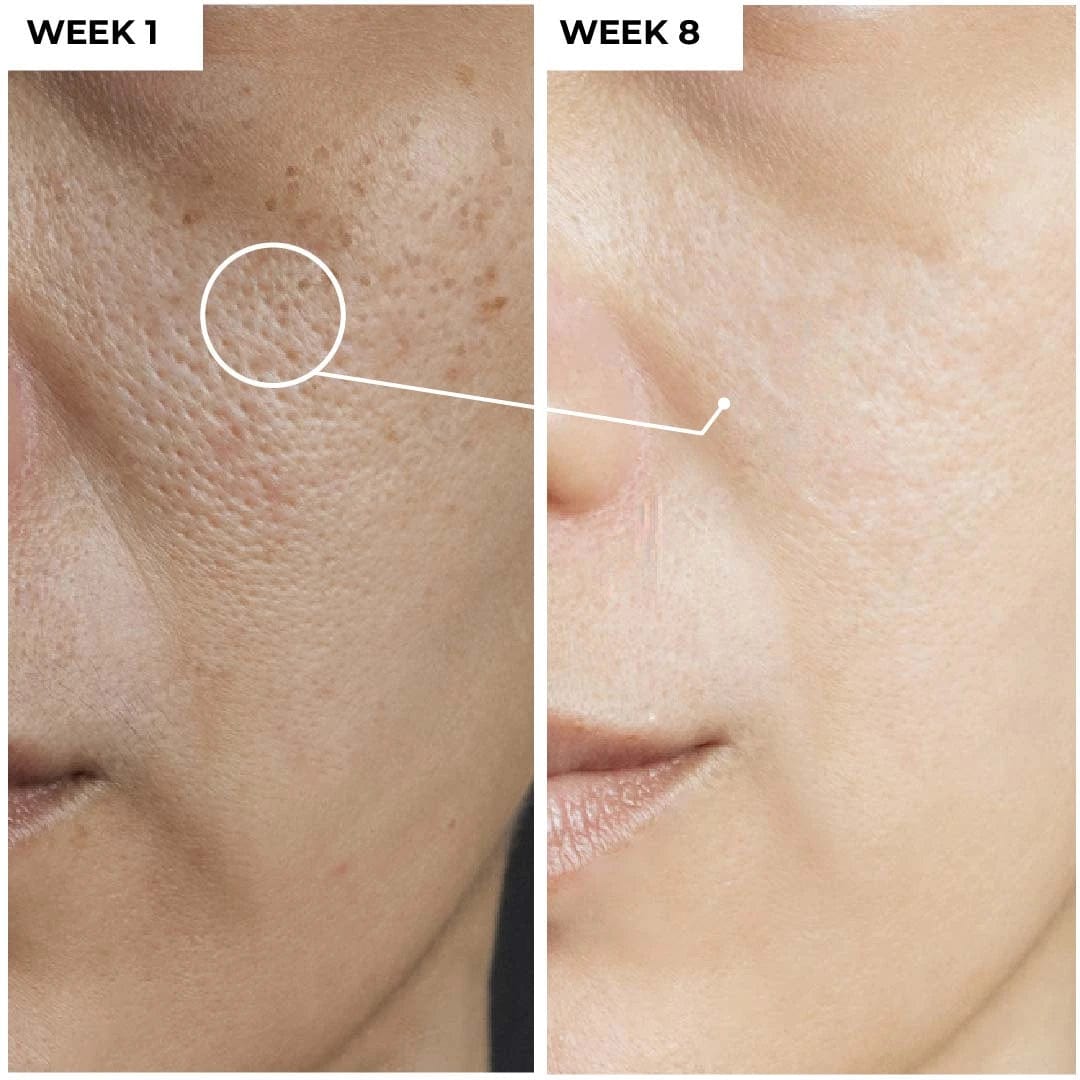 5% Niacinamide Serum + 1% Hyaluronic acidDermabay