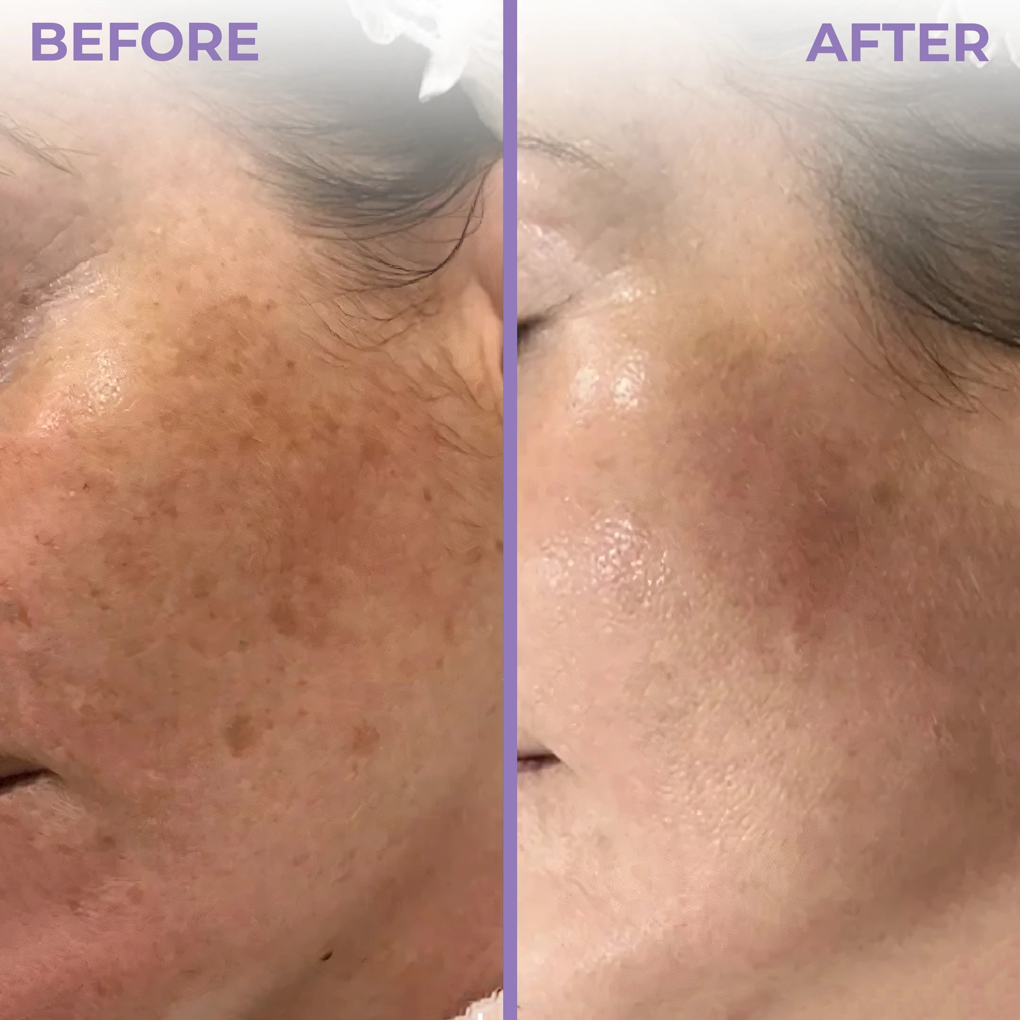 anti pigmentation combo before and after
